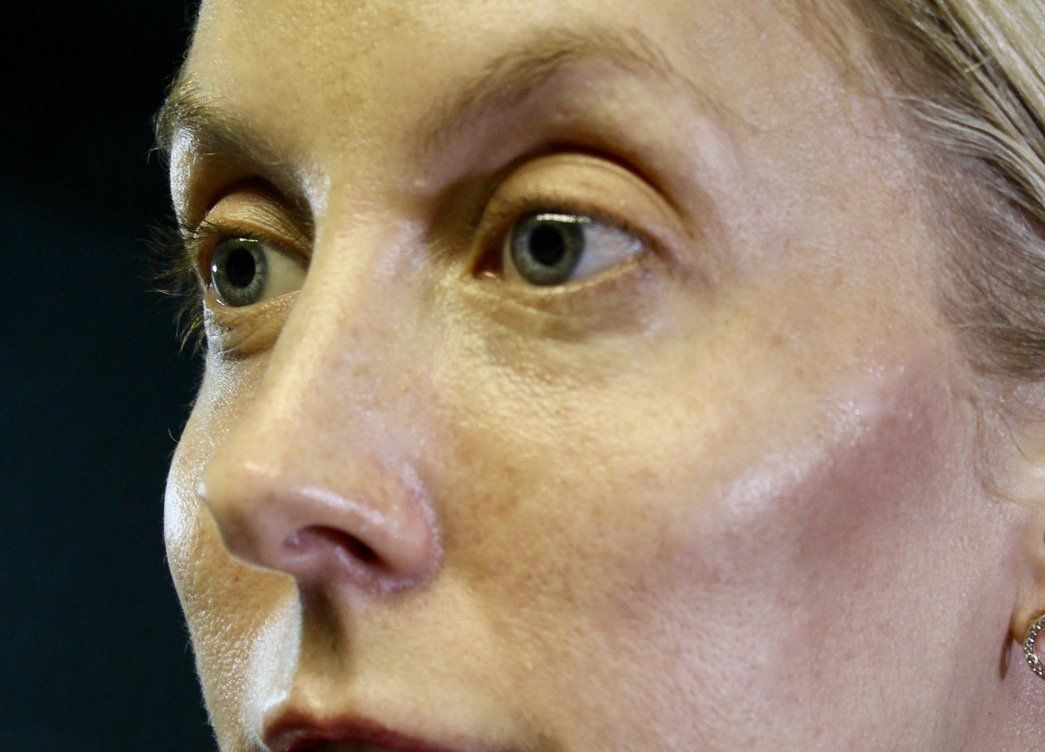 Picture of Cheek Augmentation Corrected by Dr Ruth Brady