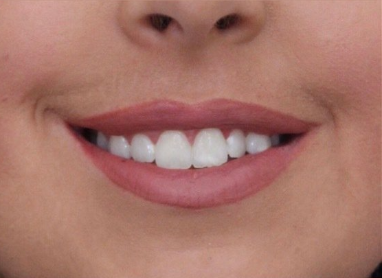 Picture of Gummy Smile Corrected by Dr Ruth Brady