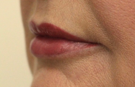 Picture of Lips Corrected by Dr Ruth Brady