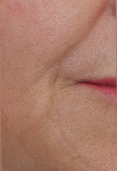 Picture of Naso-Labial & Marionette Folds Corrected by Dr Ruth Brady