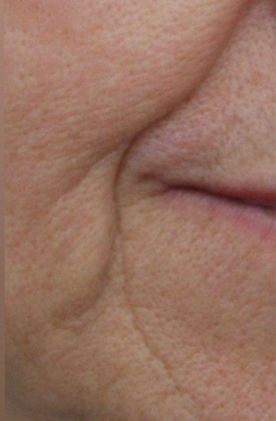 Naso-Labial & Marionette Folds Before PIcture Dr Ruth Brady