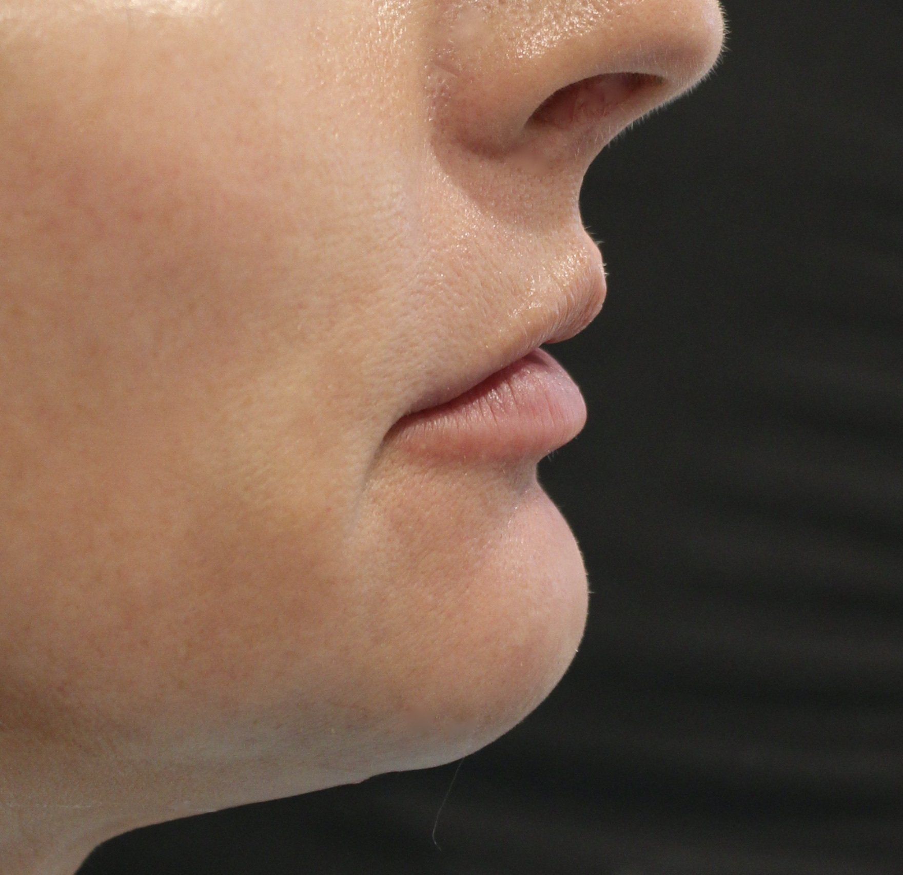 Picture of Chin Corrected by Dr Ruth Brady