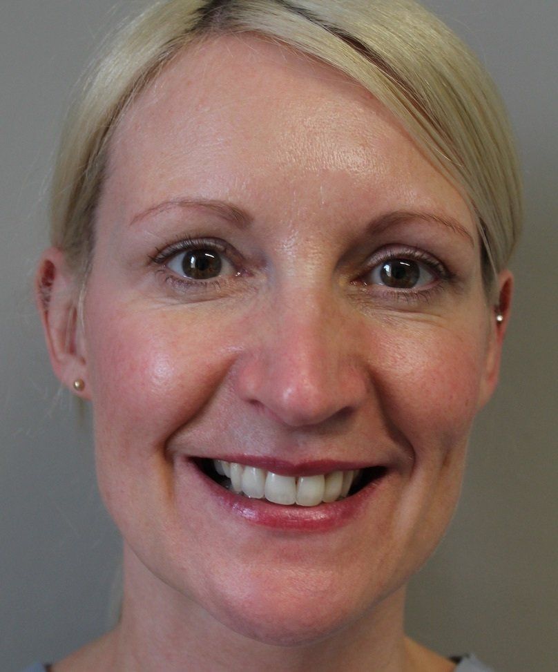 Picture of full face refresh anti-wrinkle treatment by Dr Ruth Brady