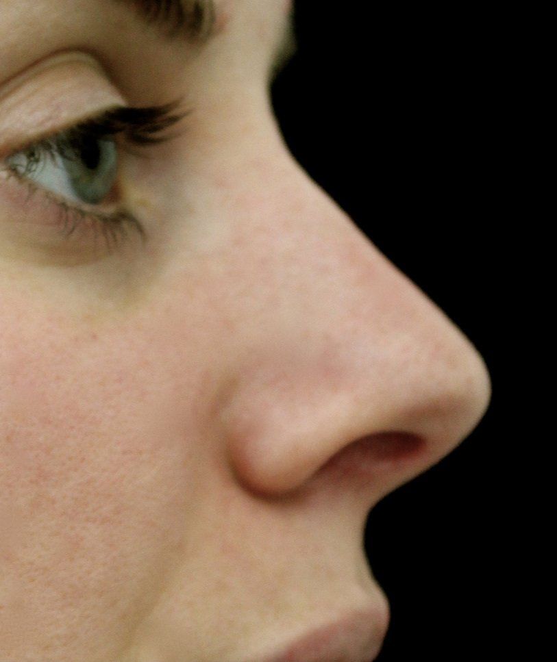 Picture of Nose Corrected by Dr Ruth Brady
