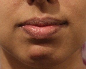 Chin Augmentation Before PIcture Dr Ruth Brady