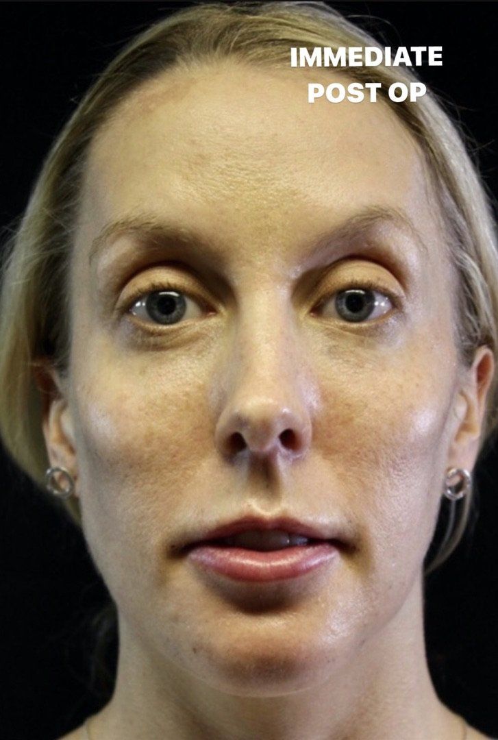 Case study of full face treatment by Dr Ruth Brady