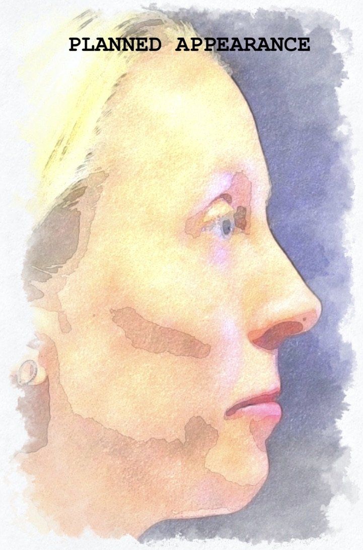 Case study of full face treatment by Dr Ruth Brady