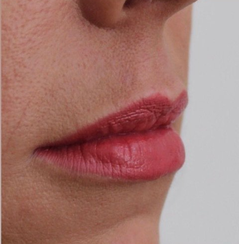 Picture of Lips Corrected by Dr Ruth Brady