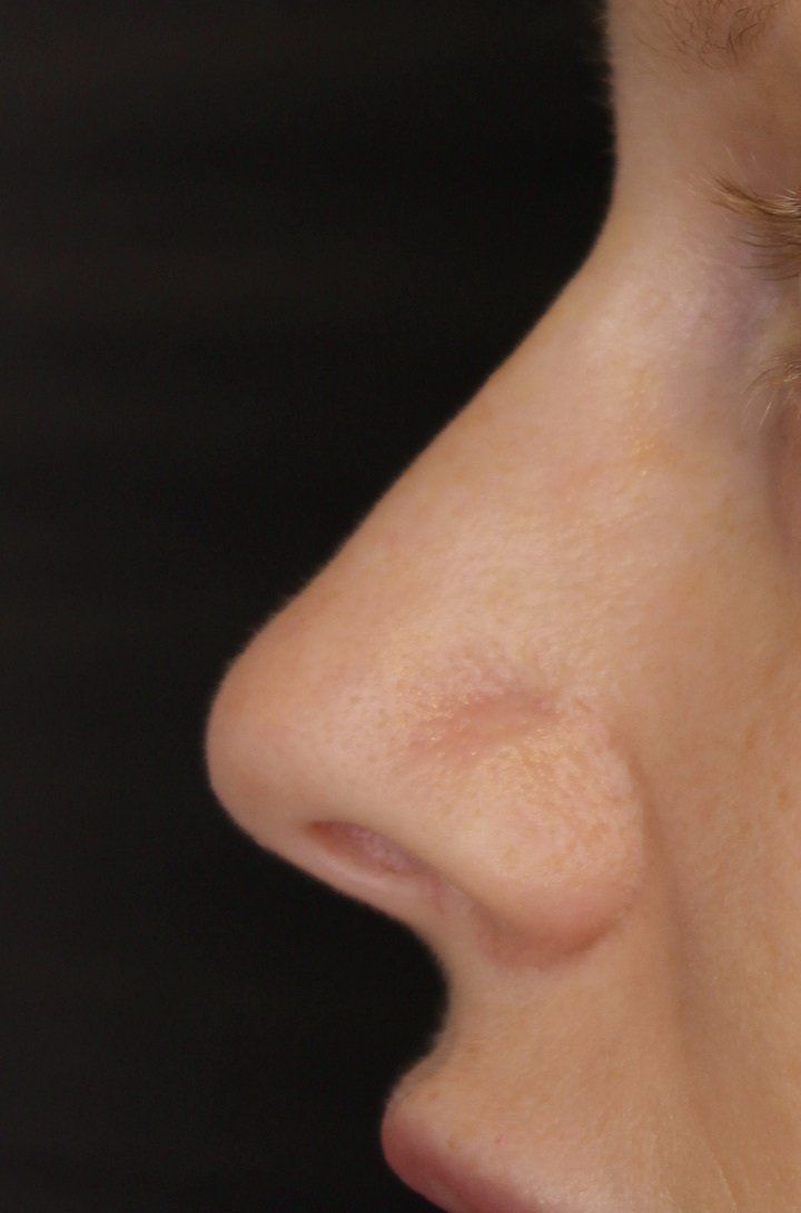 Picture of Nose Corrected by Dr Ruth Brady