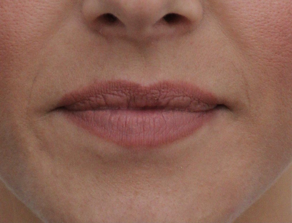 Lips Before Picture Dr Ruth Brady
