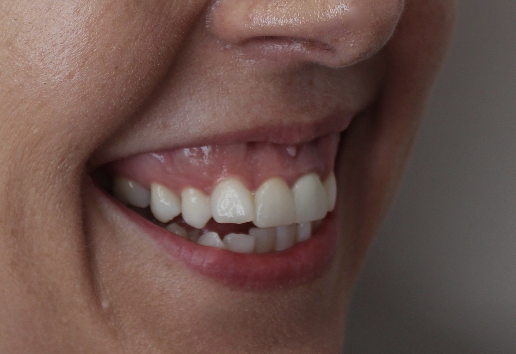 Picture of Gummy Smile anti-wrinkle treatment by Dr Ruth Brady