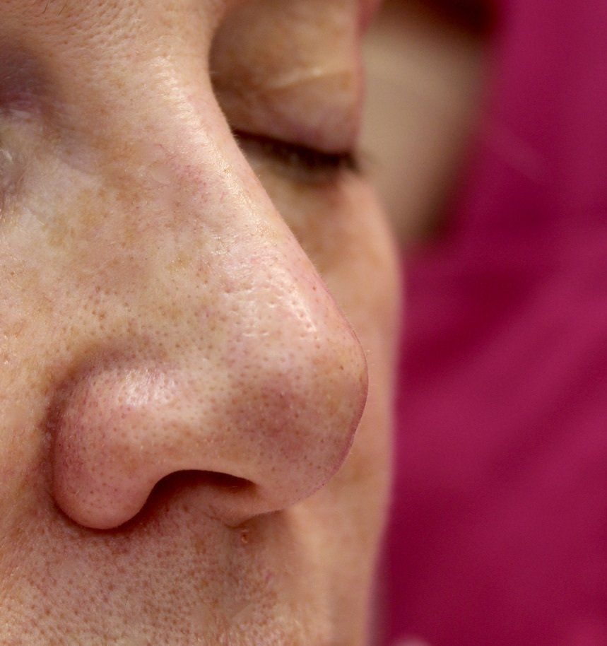 Picture of Nose Corrected by Dr Ruth Brady