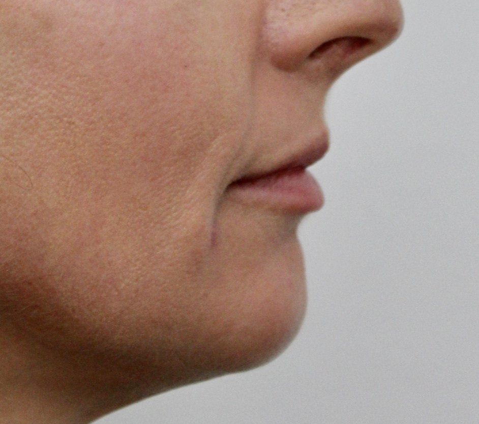 Chin Augmentation Before PIcture Dr Ruth Brady