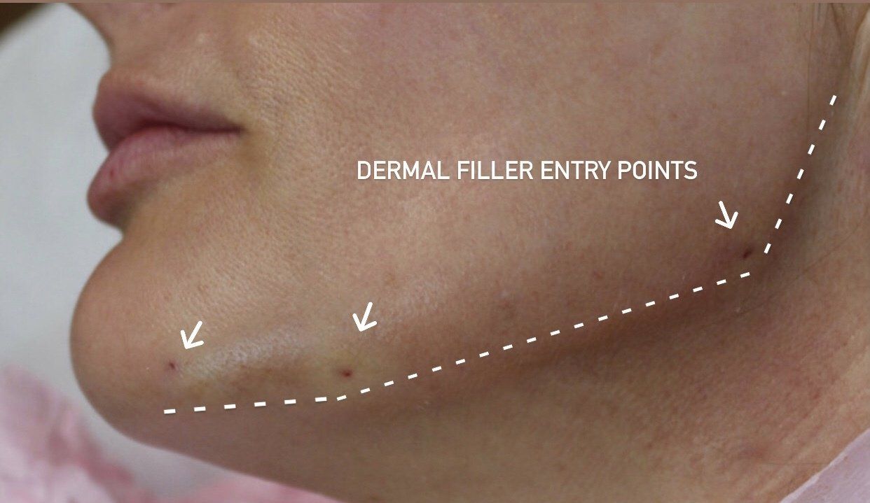 Aged Lower face Before PIcture Dr Ruth Brady