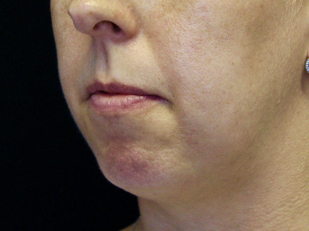 Chin Augmentation Before PIcture Dr Ruth Brady