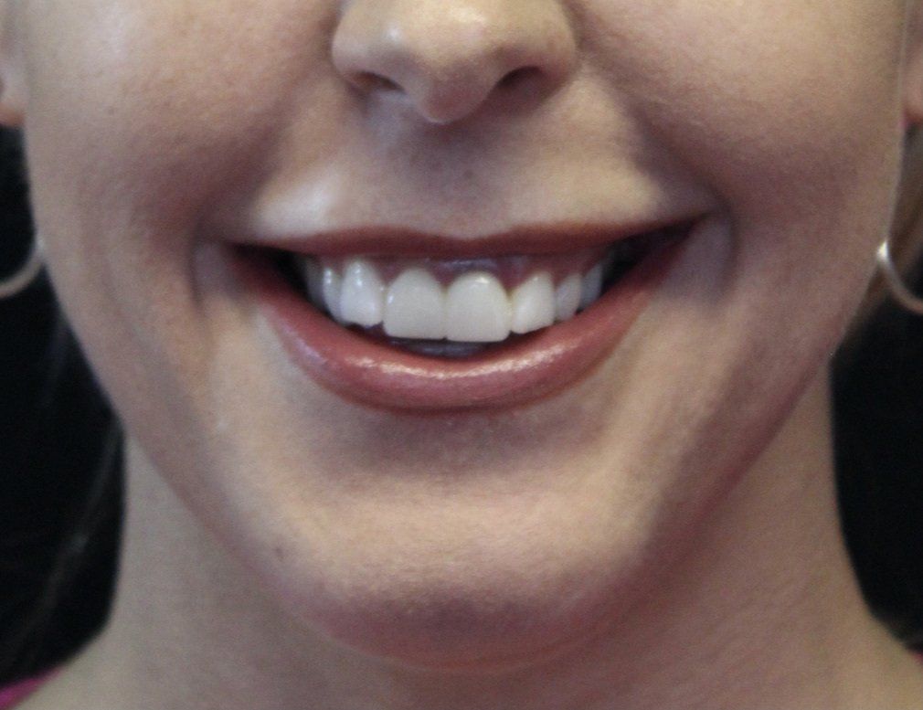 Gummy Smile After Picture Dr Ruth Brady