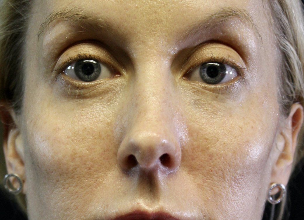 Picture of Cheek Augmentation Corrected by Dr Ruth Brady