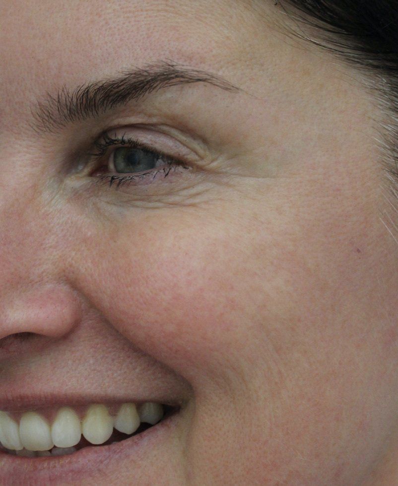 Picture of crows feet anti-wrinkle treatment by Dr Ruth Brady