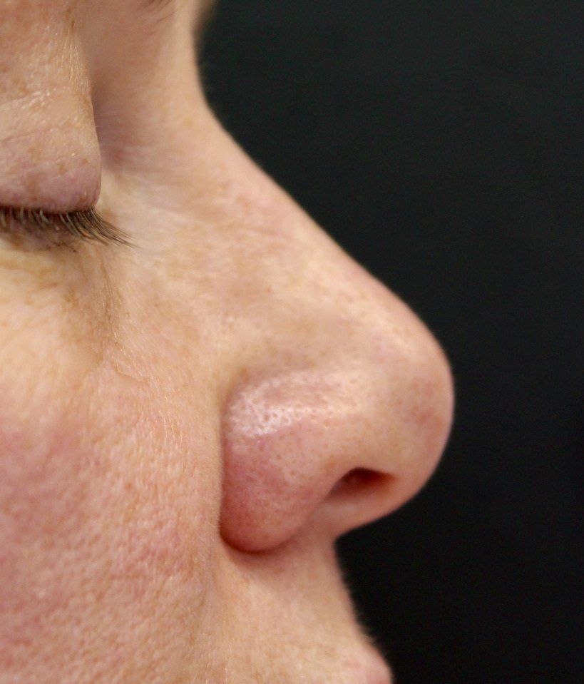 Picture of Nose Corrected by Dr Ruth Brady