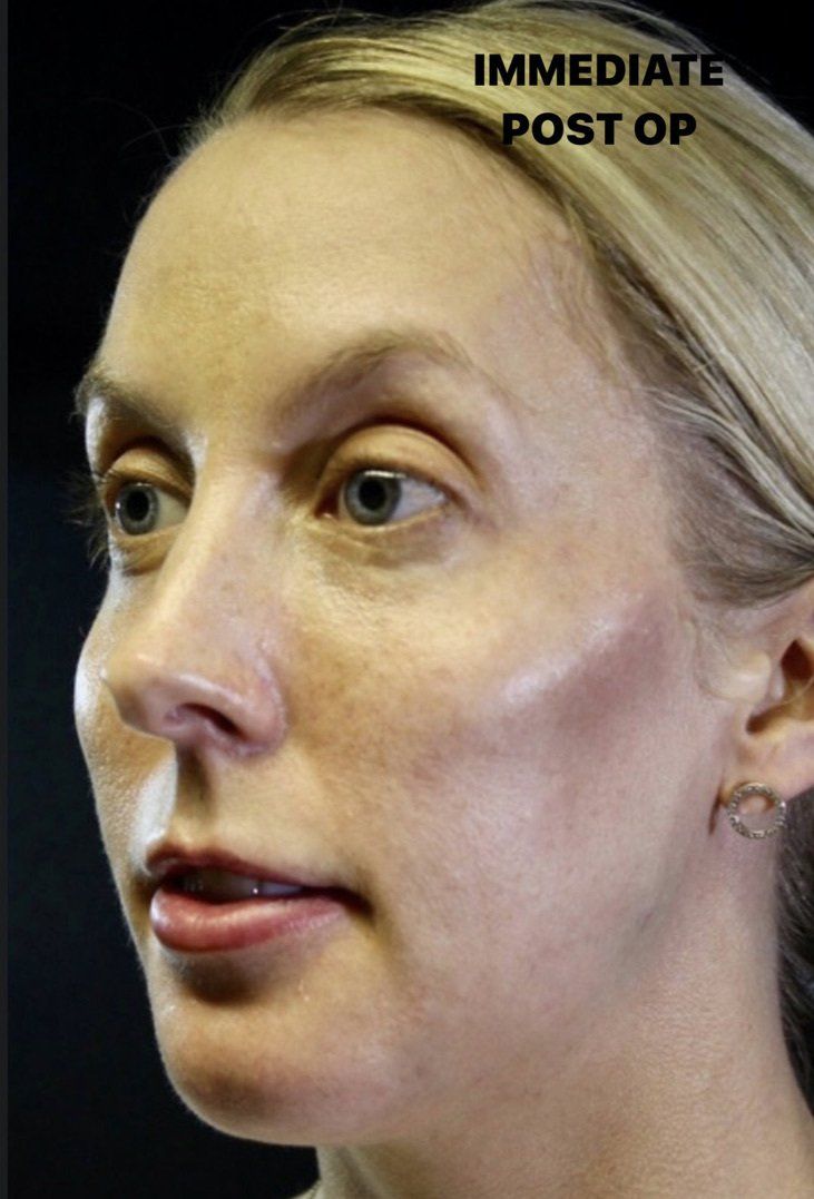 Case study of full face treatment by Dr Ruth Brady