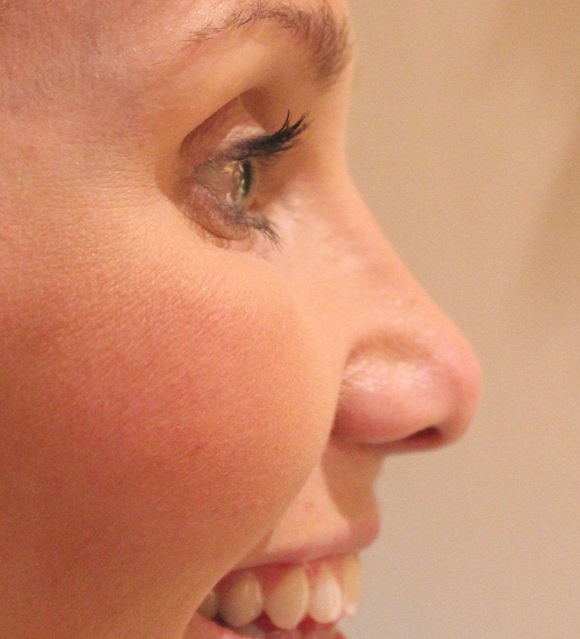 Picture of crows feet anti-wrinkle treatment by Dr Ruth Brady