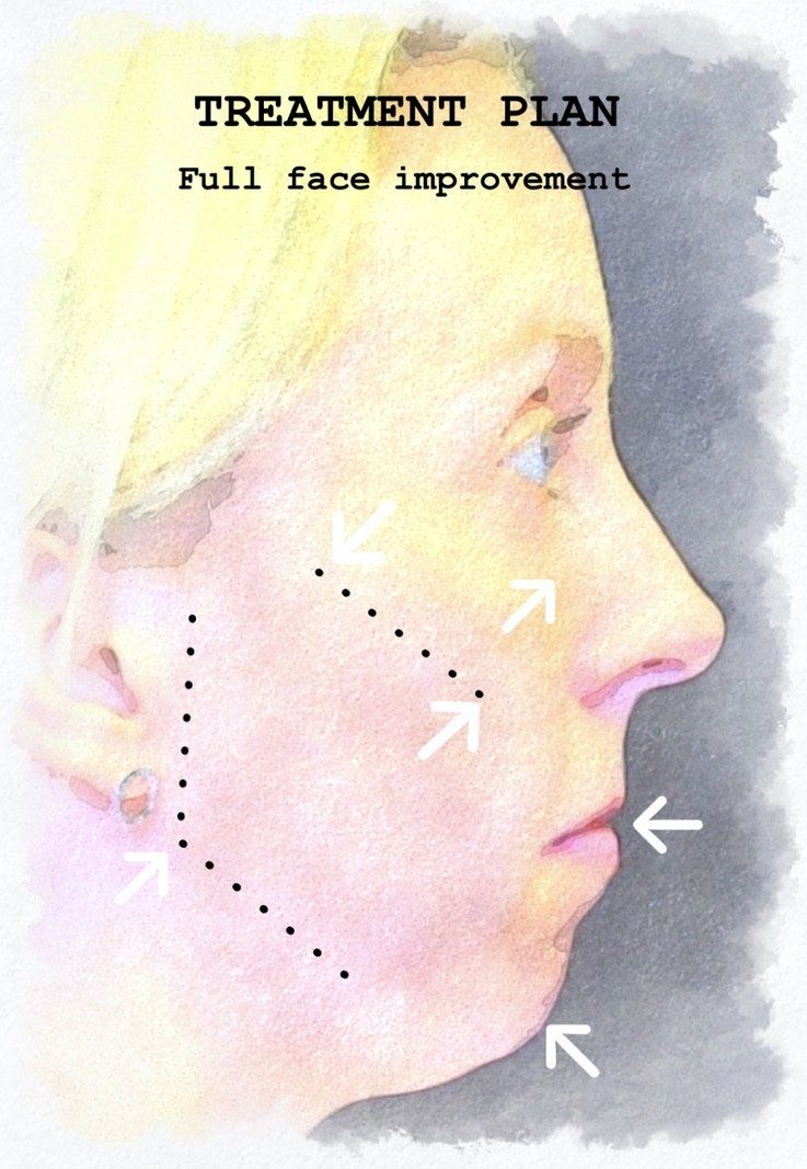 Case study of full face treatment by Dr Ruth Brady