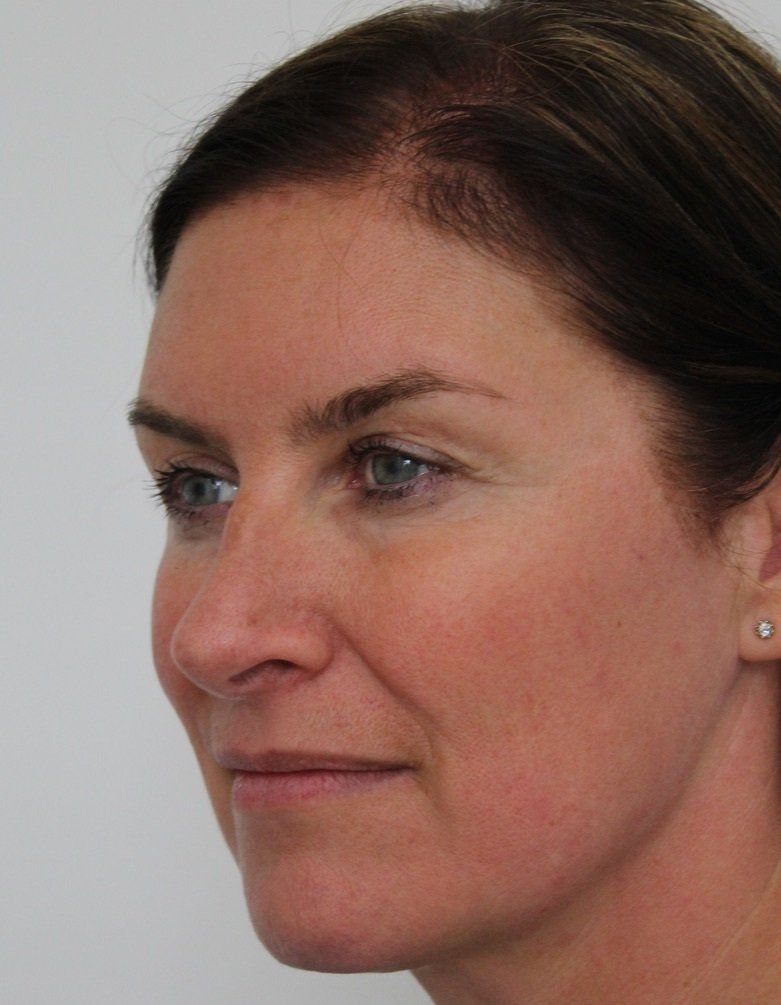 Picture of full face refresh anti-wrinkle treatment by Dr Ruth Brady