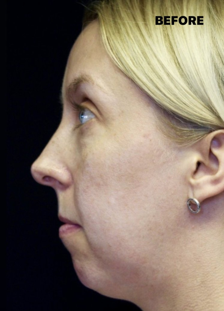 Case study of full face treatment by Dr Ruth Brady