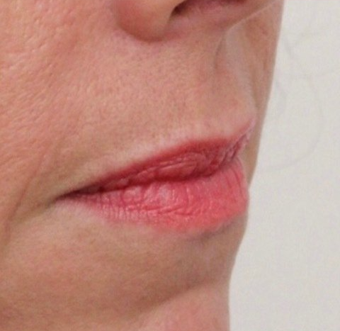 Lips Before Picture Dr Ruth Brady
