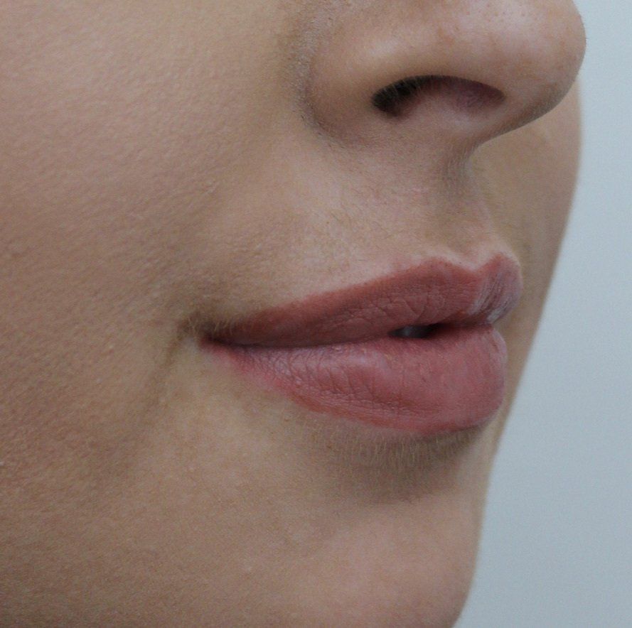 Picture of Lips Corrected by Dr Ruth Brady