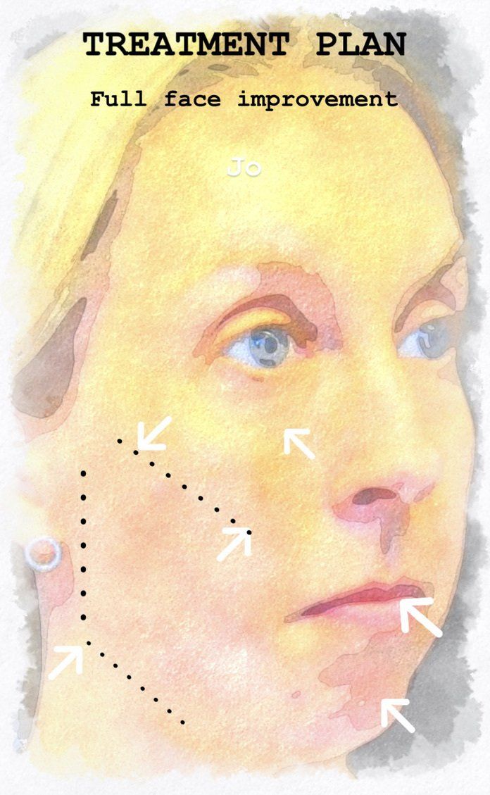 Case study of full face treatment by Dr Ruth Brady