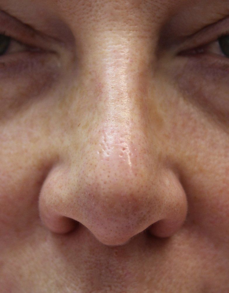 Picture of Nose Corrected by Dr Ruth Brady