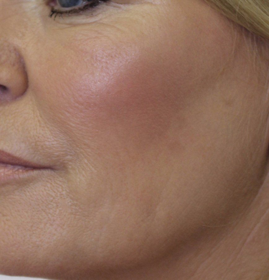 Picture of Cheek Corrected by Dr Ruth Brady