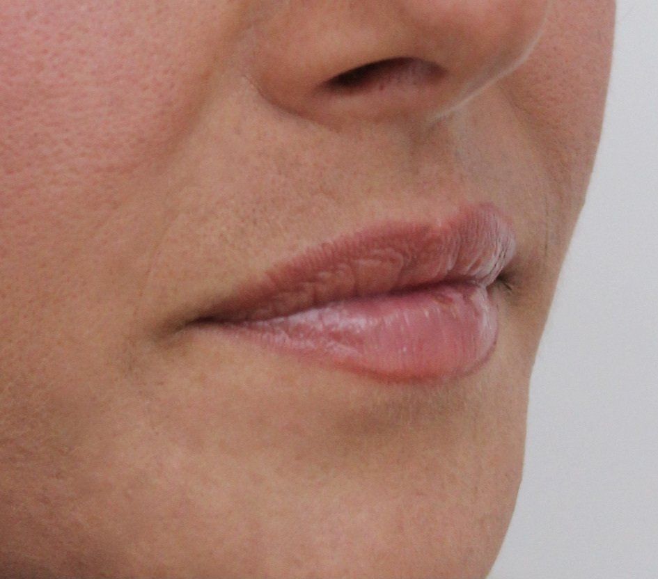Lips Before Picture Dr Ruth Brady