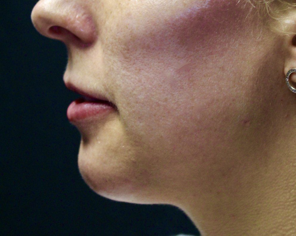 Picture of Chin Corrected by Dr Ruth Brady