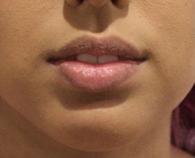Picture of Chin Corrected by Dr Ruth Brady