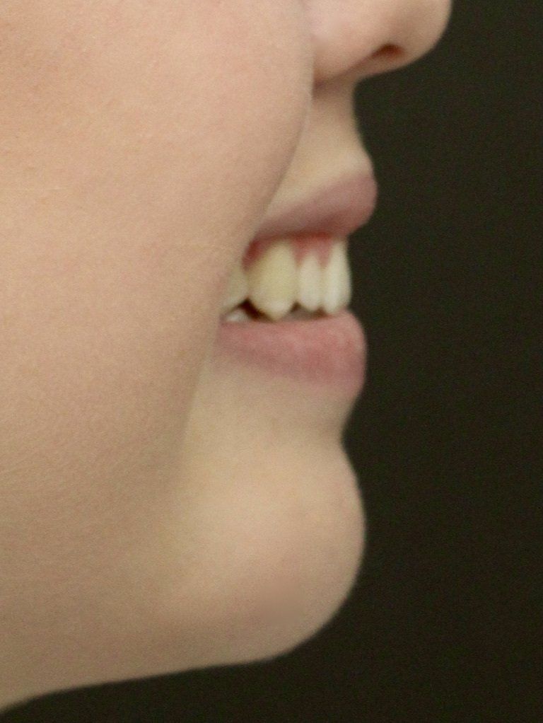 Picture of Chin Corrected by Dr Ruth Brady