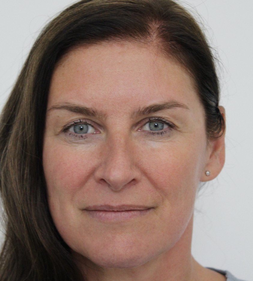 Picture of full face refresh anti-wrinkle treatment by Dr Ruth Brady