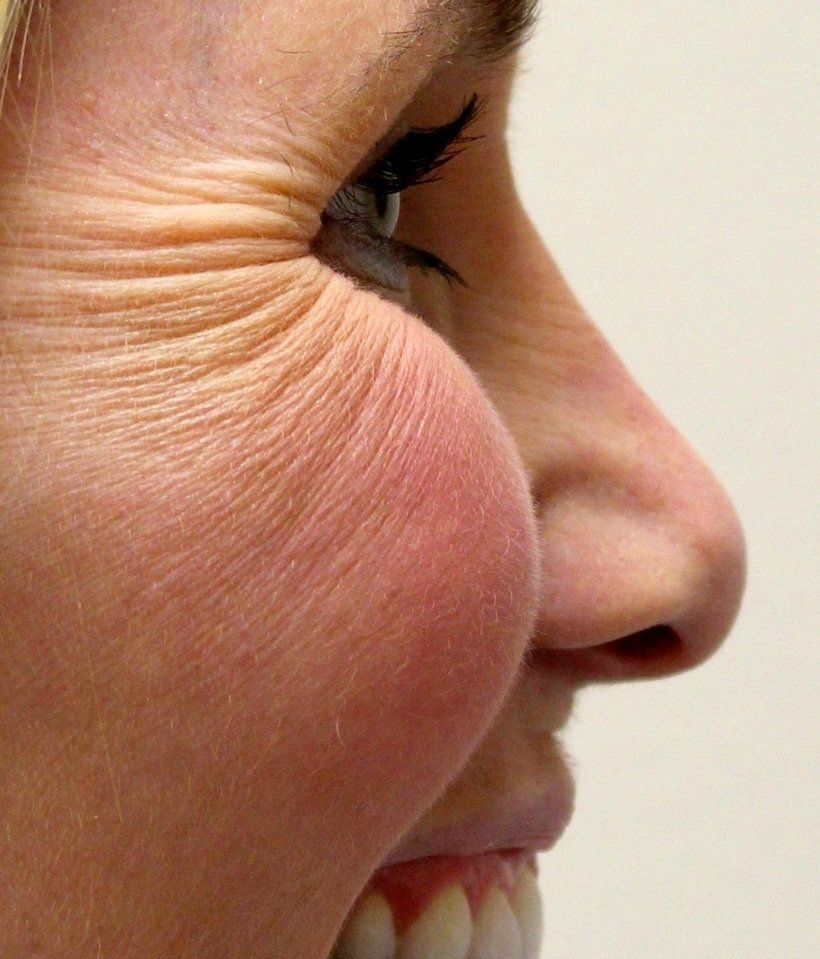 Crows Feet Before Picture Dr Ruth Brady