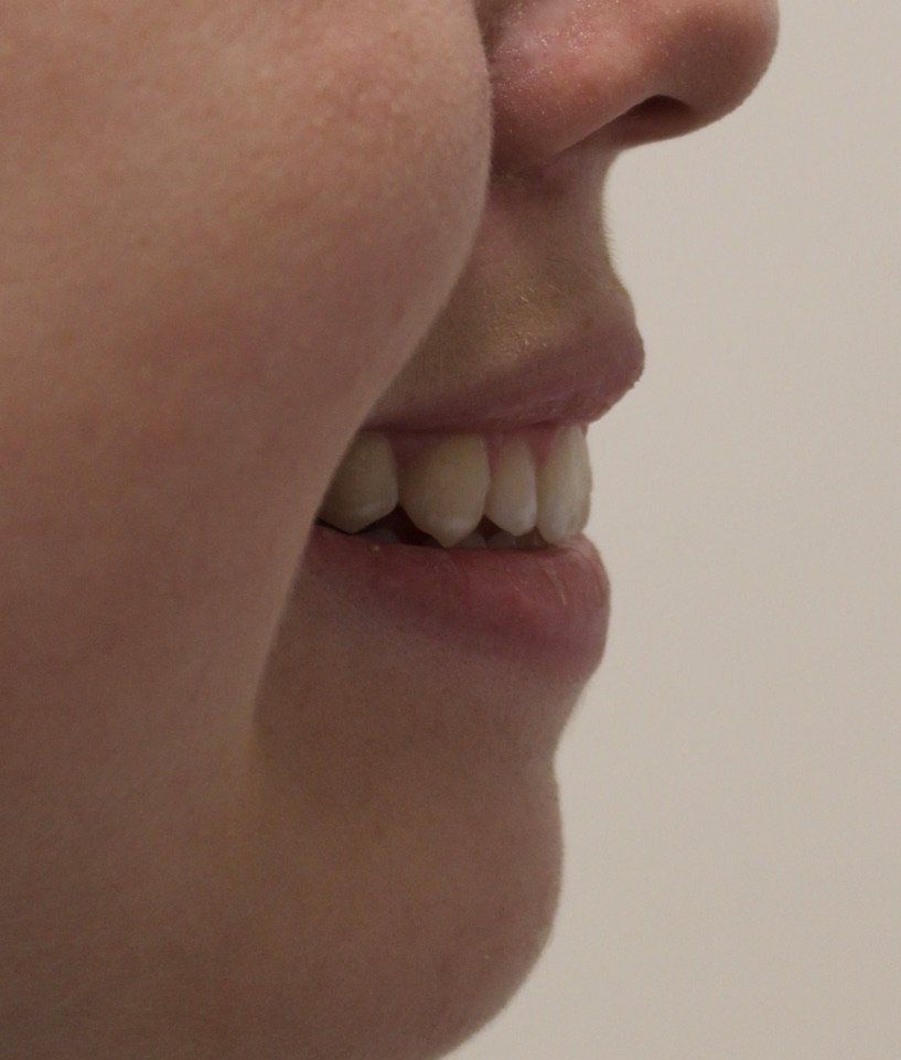 Picture of Gummy Smile anti-wrinkle treatment by Dr Ruth Brady