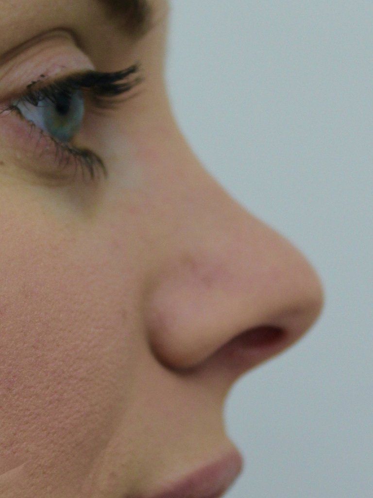 Nose Augmentation Before PIcture Dr Ruth Brady