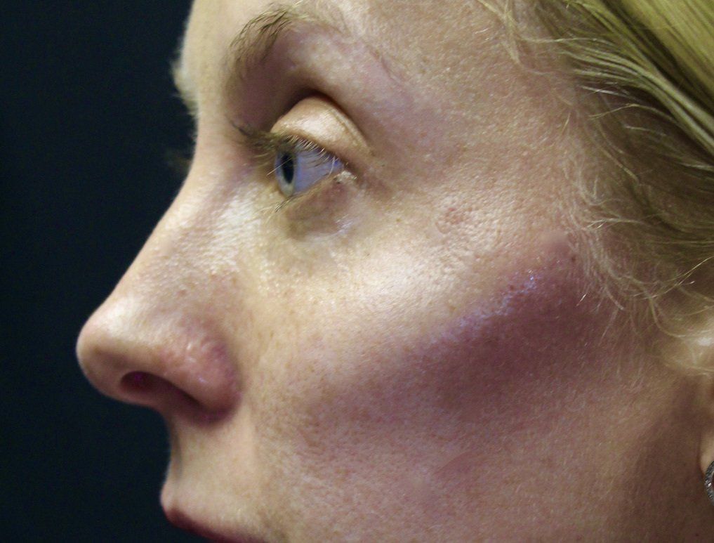 Picture of Cheek Augmentation Corrected by Dr Ruth Brady