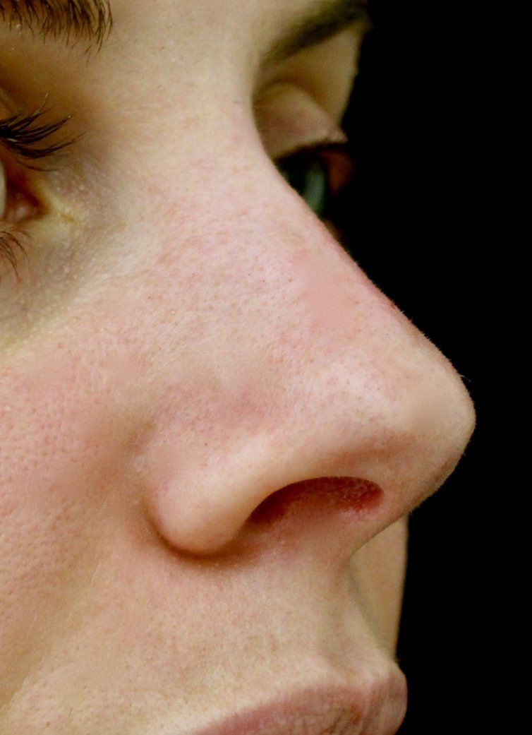 Picture of Nose Corrected by Dr Ruth Brady