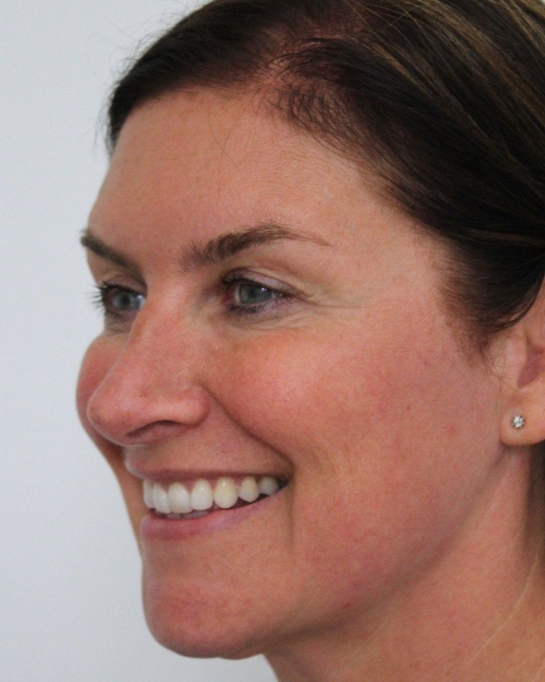 Picture of full face refresh anti-wrinkle treatment by Dr Ruth Brady