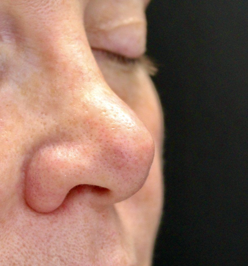 Nose Augmentation Before PIcture Dr Ruth Brady