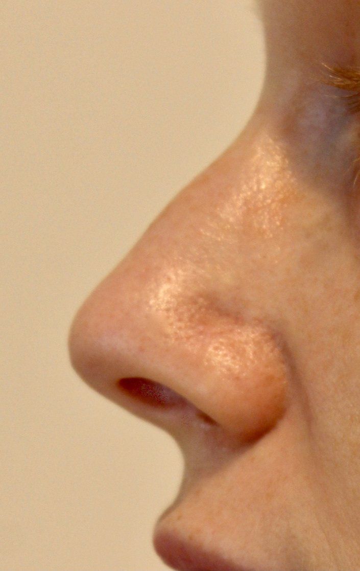 Nose Augmentation Before PIcture Dr Ruth Brady