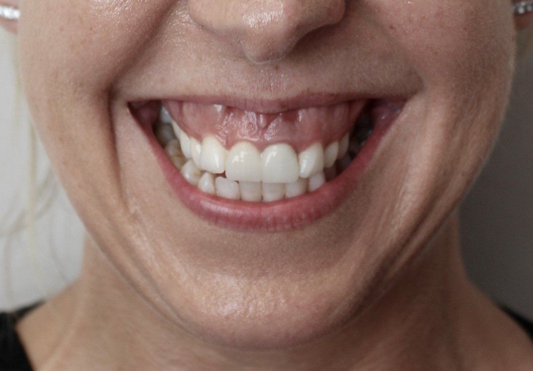 Picture of Gummy Smile anti-wrinkle treatment by Dr Ruth Brady