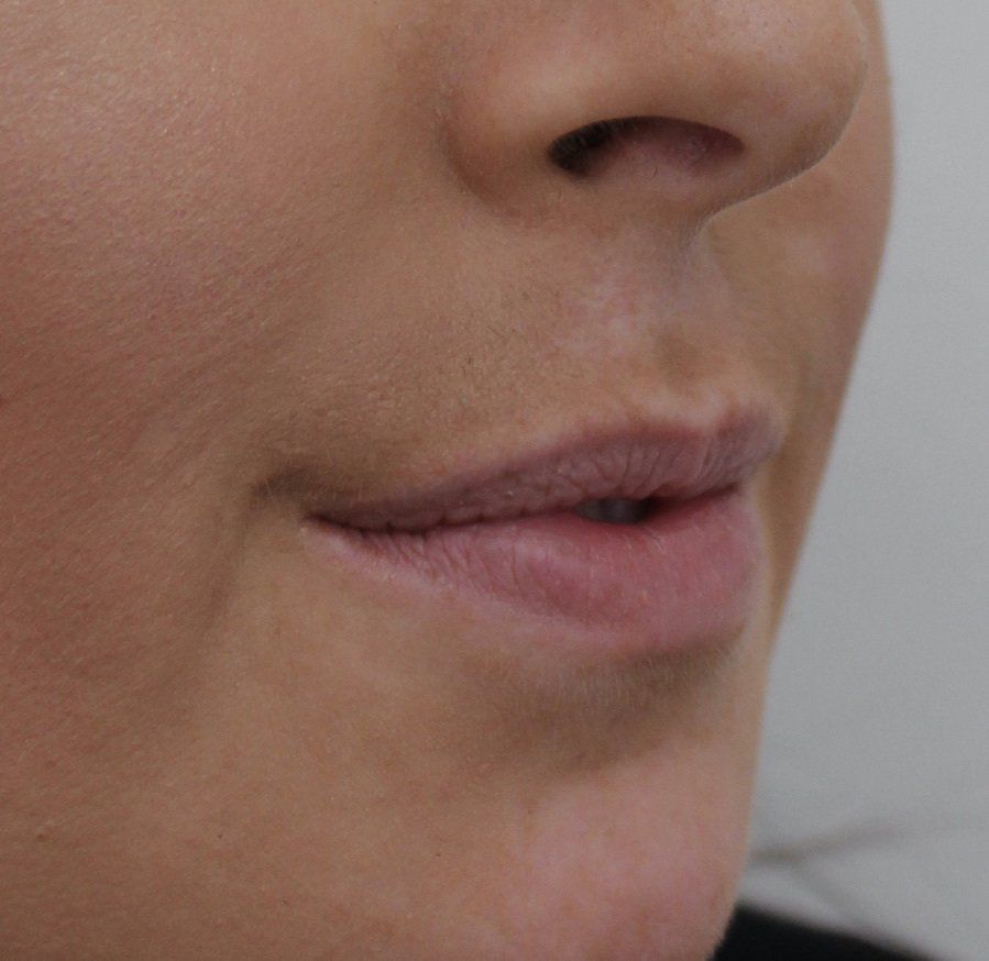 Lips Before Picture Dr Ruth Brady