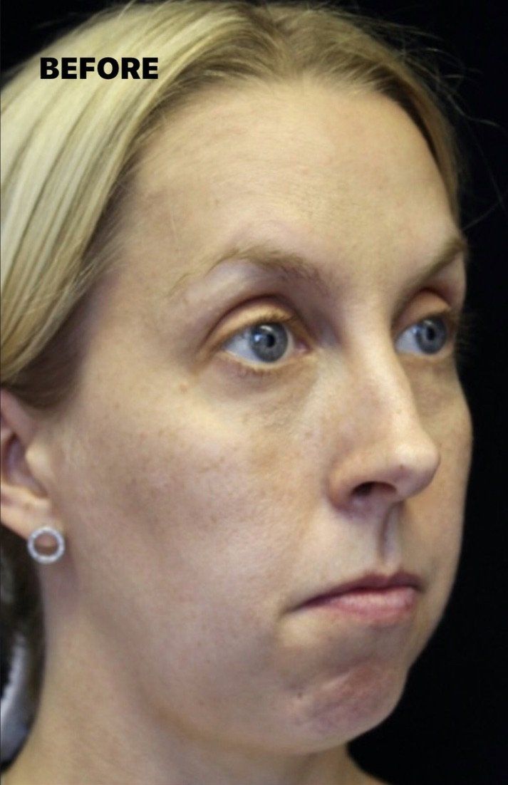 Case study of full face treatment by Dr Ruth Brady