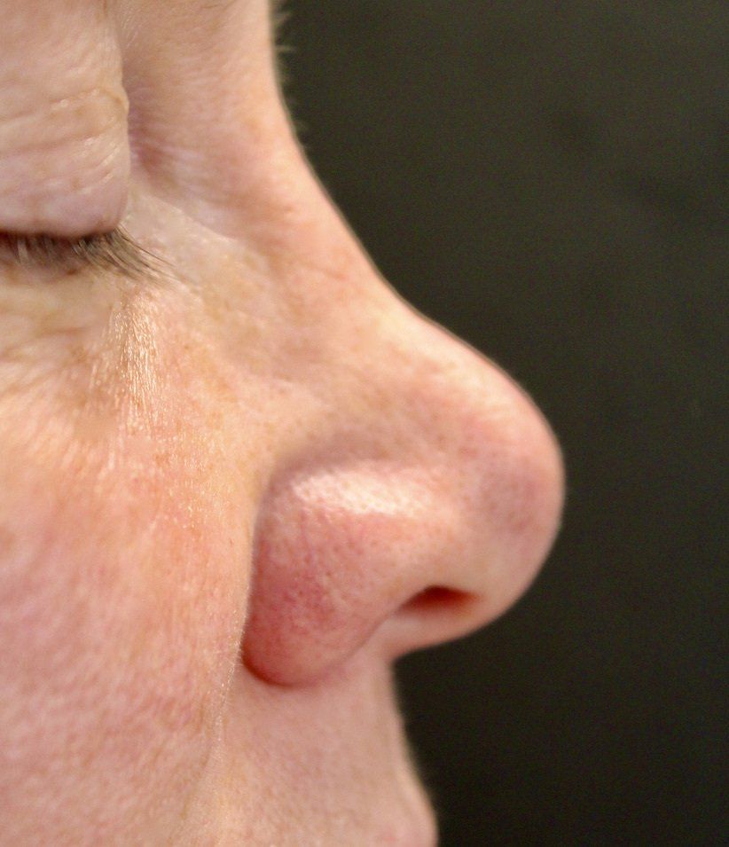Nose Augmentation Before PIcture Dr Ruth Brady